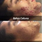 celluma acne treatment