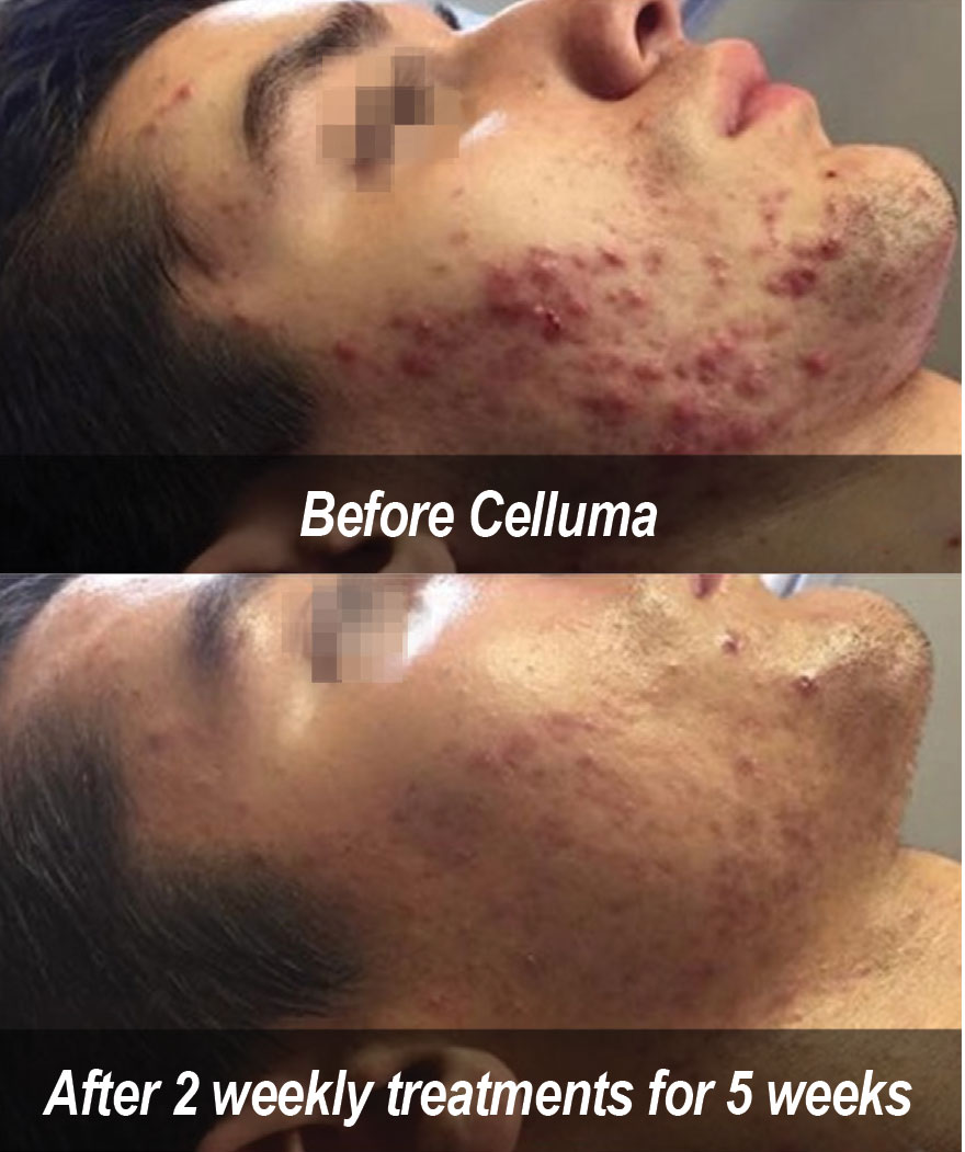 celluma acne treatment