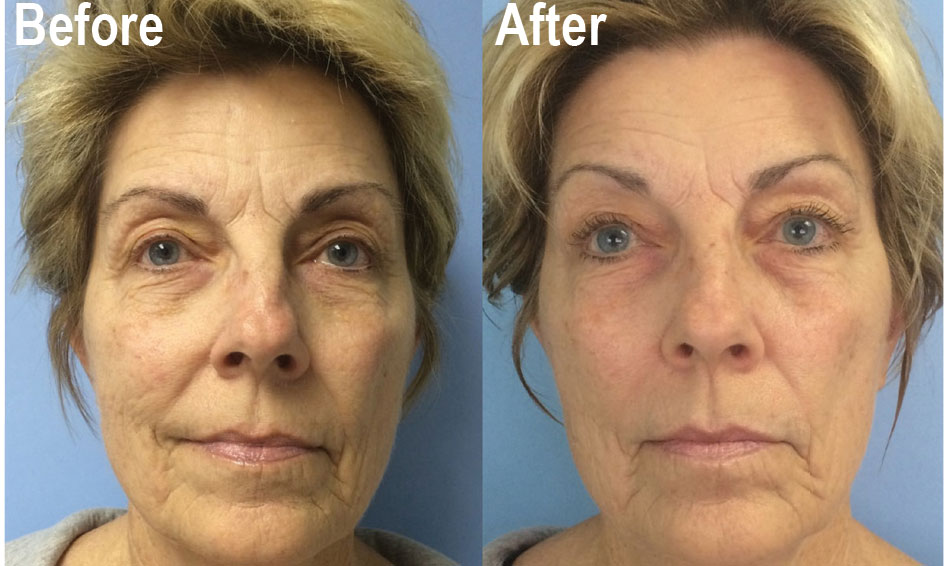 celluma fine lines treatment